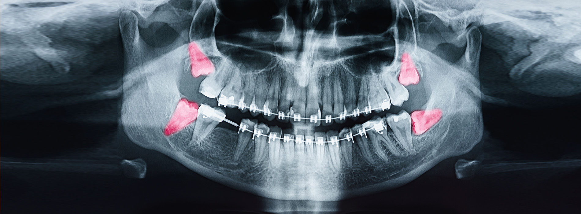 The image shows a close-up view of a person s teeth and oral cavity, with a focus on the dental implants and braces, against a dark background.