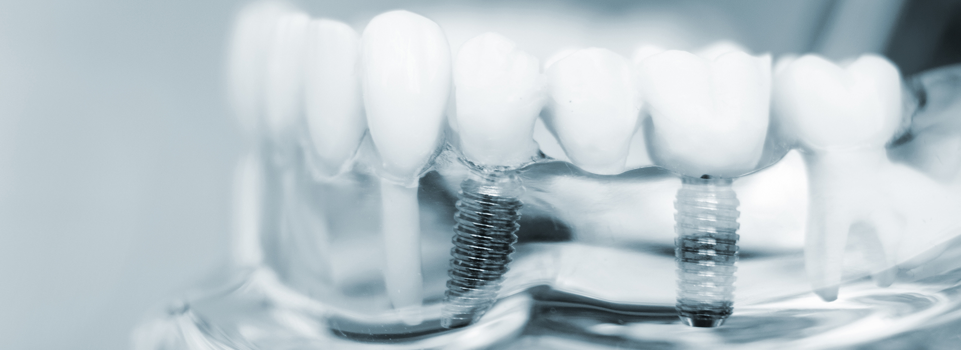 The image shows a close-up of multiple dental implants with visible screws, set against a blurred background.